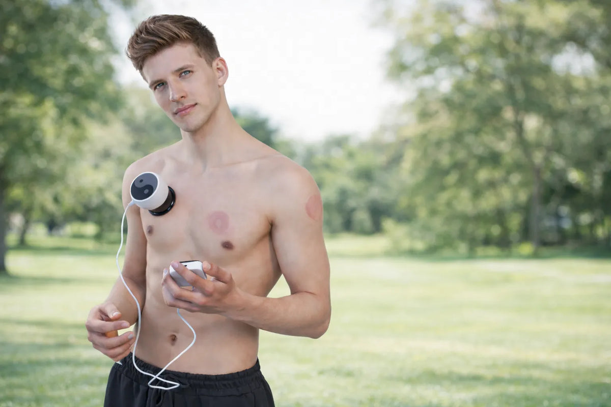 Cupping for Lower Back Pain