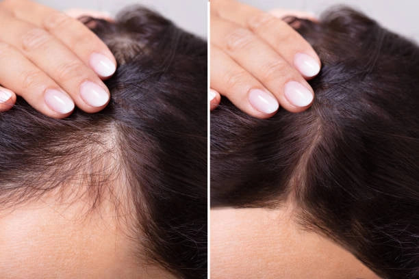 Side-by-side comparison of hair improvement of scalp by using NUE scalp massager brush